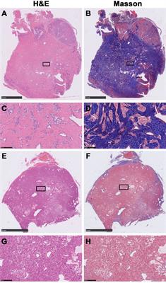 Long-Term Surgical Outcomes of Carotid Body Tumors With Pathological Fibrosis: A Cohort Study